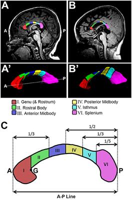 Impact of Infant Thoracic Non-cardiac Perioperative Critical Care on Homotopic-Like Corpus Callosum and Forebrain Sub-regional Volumes